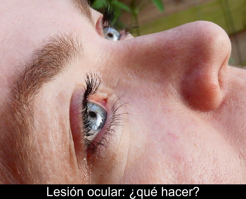 Lesión Ocular: ¿qué Hacer?