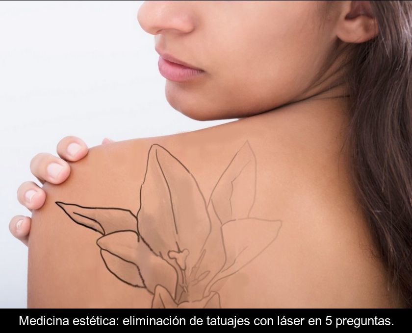 Medicina Estética: Eliminación De Tatuajes Con Láser En 5 Preguntas.