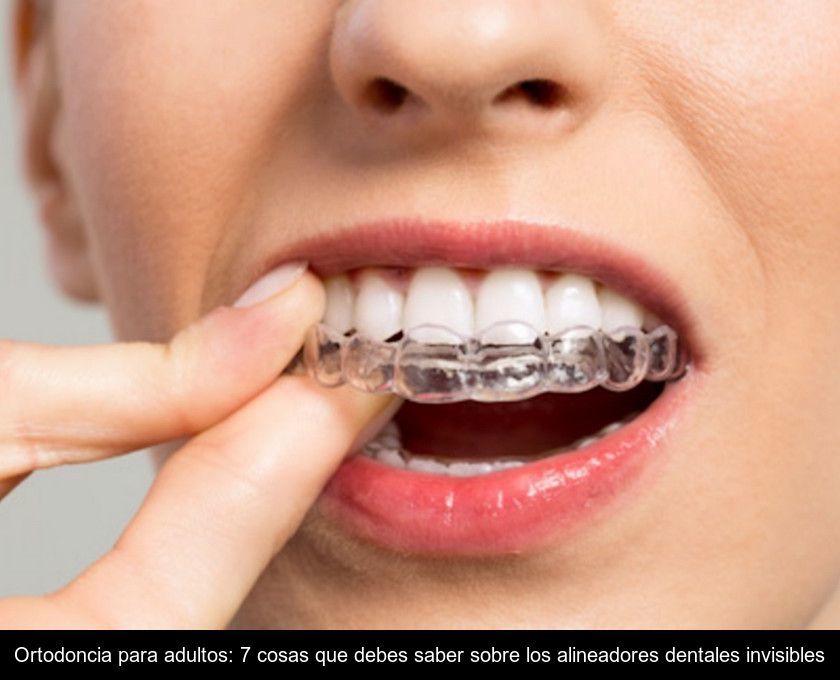 Ortodoncia Para Adultos: 7 Cosas Que Debes Saber Sobre Los Alineadores Dentales Invisibles