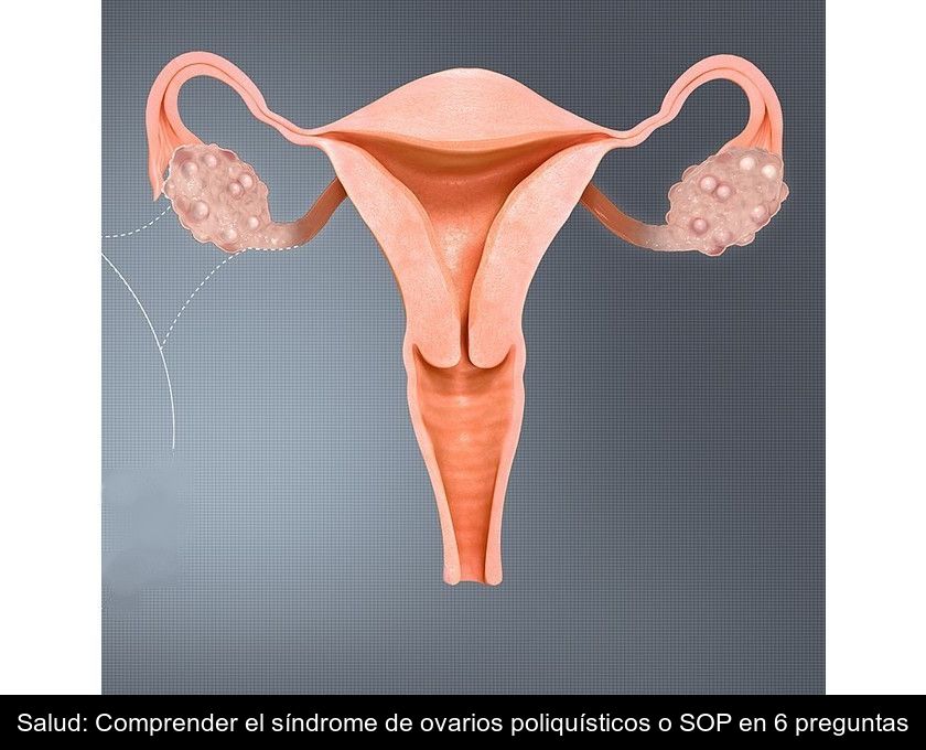 Salud: Comprender El Síndrome De Ovarios Poliquísticos O Sop En 6 Preguntas