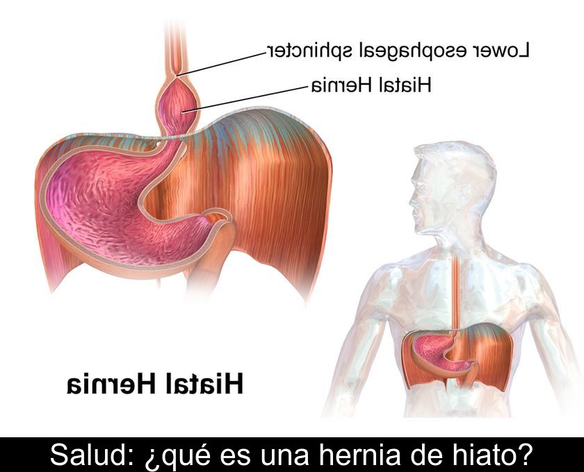 Salud: ¿qué Es Una Hernia De Hiato?