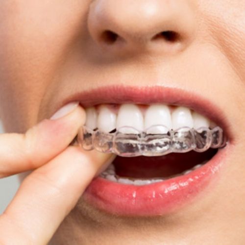 Ortodoncia para adultos: 7 cosas que debes saber sobre los alineadores dentales invisibles