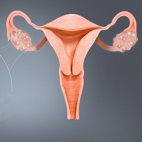 Salud: Comprender el síndrome de ovarios poliquísticos o SOP en 6 preguntas