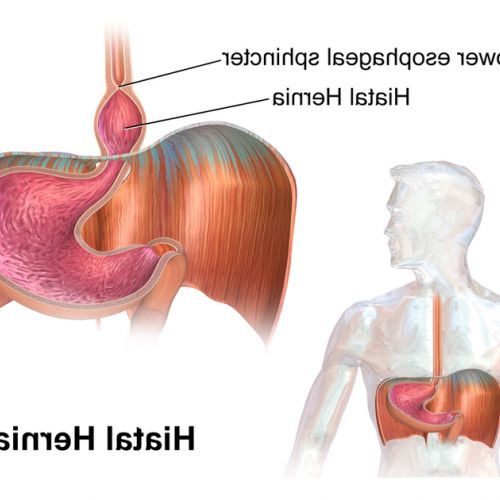 Salud: ¿qué es una hernia de hiato?